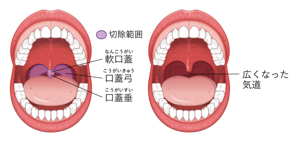 切除範囲：軟口蓋（なんこうがい）、口蓋弓（こうがいきゅう）、口蓋垂（こうがいすい）