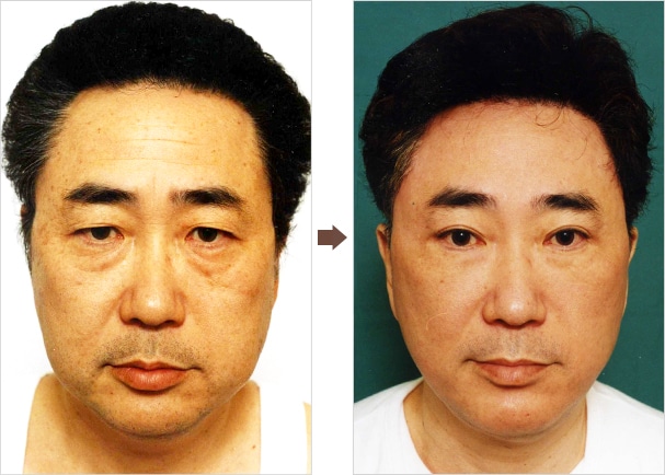美容整形で口角を上げるにはどうしたら良いのか Dr 高須幹弥の美容整形講座 美容整形の高須クリニック