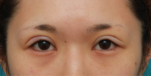 二重まぶたミニ切開法 全切開法 眼瞼下垂手術の術後はどれくらい腫れるのか Dr 高須幹弥の美容整形講座 美容整形の高須クリニック