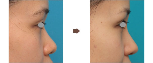 鼻や顎のシリコンプロテーゼや耳介軟骨移植は術後にずれることはあるのか Dr 高須幹弥の美容整形講座 美容整形の高須クリニック