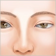 二重まぶた・目もとの他院修正