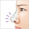 他院で受けた手術の修正（鼻）
