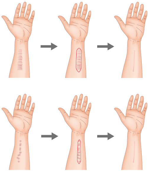 リストカットや根性焼き痕の治療について Dr 高須幹弥の美容整形講座 美容整形の高須クリニック