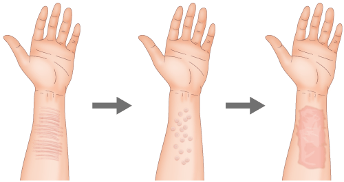 ・切除縫合では対応できない広範囲の場合は、専用の機器で皮膚表面を細かく剥離。　・仕上がりは、熱湯をかぶってできた火傷のような傷跡に。　・手術時間は範囲にもよるが、60分未満であることが多い。　・術後しばらくは赤く盛り上がっているが、時間の経過とともに赤みが引いて平らになってくる。
