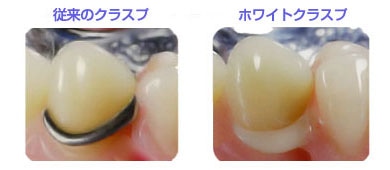 従来のクラスブ ホワイトクラスプ