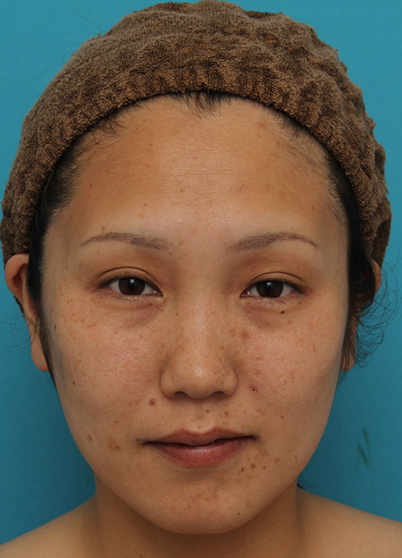 症例写真,30代女性に目尻切開・垂れ目形成を行い、目を一回り大きくした症例写真,Before,ba_mejiri019_b01.jpg