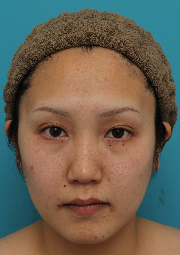 症例写真,30代女性に目尻切開・垂れ目形成を行い、目を一回り大きくした症例写真,3ヶ月後,mainpic_mejiri019e.jpg