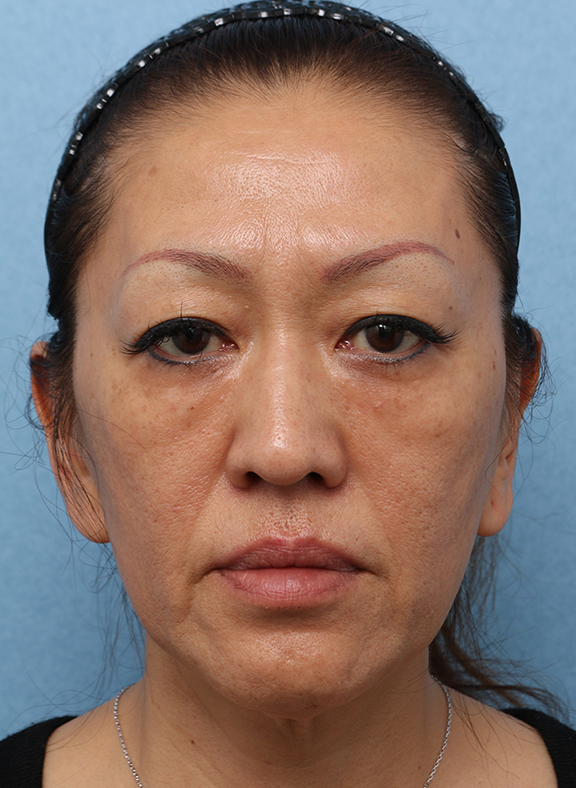 症例写真,Vシェイプリフト（ヒアルロン酸注射） 50代女性の症例写真,After（3ヶ月後）,ba_v_shapelift013_b01.jpg