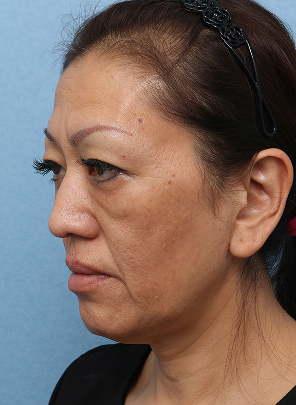 症例写真,Vシェイプリフト（ヒアルロン酸注射） 50代女性の症例写真,Before,ba_v_shapelift013_b04.jpg