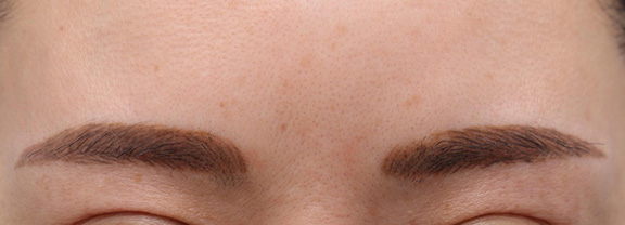 眉間のシワ取りボツリヌストキシン注射の症例写真,After（1ヶ月後）,ba_botox015_a01.jpg