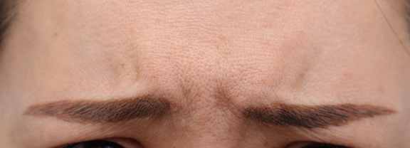 眉間のシワ取りボツリヌストキシン注射の症例写真,Before,ba_botox015_b01.jpg