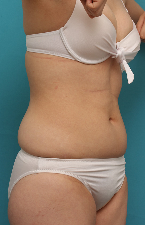 症例写真,20代女性のお腹周りを、イタリアンメソシェイプでスッキリさせた症例写真,Before,ba_meso042_b02.jpg