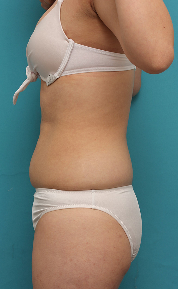 症例写真,20代女性のお腹周りを、イタリアンメソシェイプでスッキリさせた症例写真,Before,ba_meso042_b03.jpg