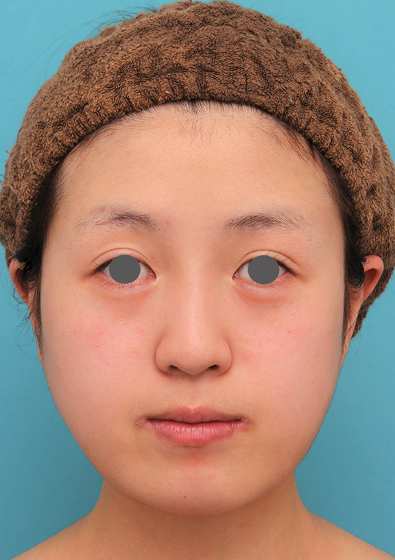 症例写真,20代女性の顎のシリコンプロテーゼの症例写真,Before,ba_ago019_b01.jpg
