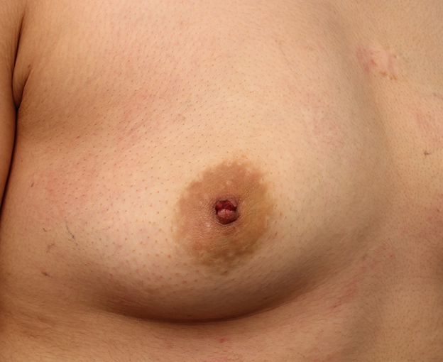 症例写真,20代女性の軽度の陥没乳頭を手術で治した症例写真,1週間後,mainpic_kanbotsu006c.jpg