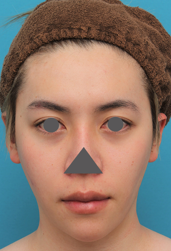 症例写真,上下の厚い唇を手術で薄くした男性の症例写真,Before,ba_usuku013_b01.jpg