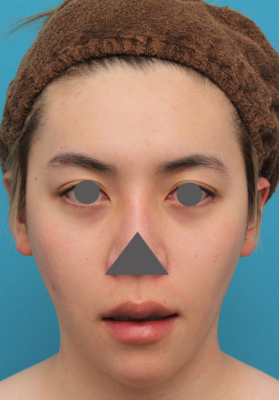 症例写真,上下の厚い唇を手術で薄くした男性の症例写真,Before,ba_usuku013_b02.jpg