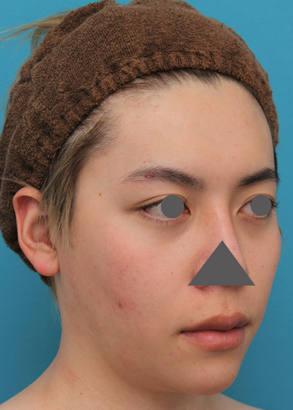 症例写真,上下の厚い唇を手術で薄くした男性の症例写真,Before,ba_usuku013_b03.jpg