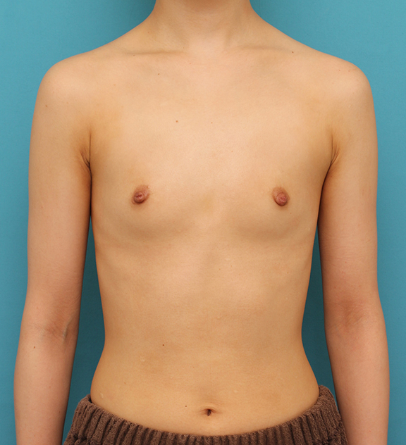 ほぼ平らな胸の20代女性にシリコンプロテーゼ豊胸手術を行った症例写真,Before,ba_hokyo033_b01.jpg