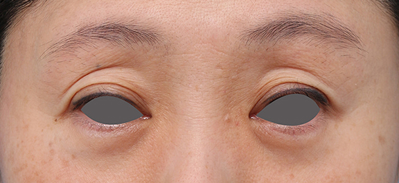 症例写真,くぼみ目のヒアルロン酸注射症例写真,Before,ba_kubomi007_b01.jpg