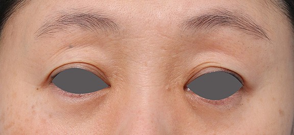 症例写真,くぼみ目のヒアルロン酸注射症例写真,1ヶ月後,mainpic_kubomi007c.jpg