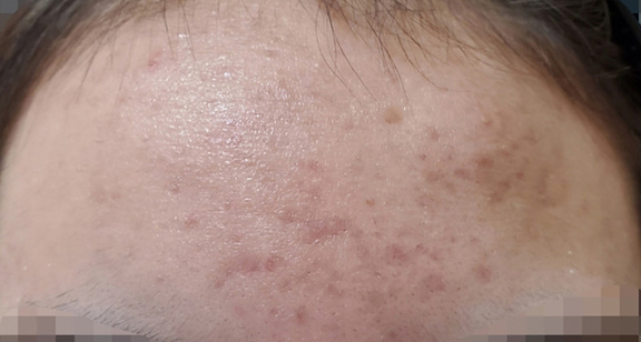 ニキビ治療の症例写真 フォトフェイシャルM22とVビームで化膿ニキビを治療,After（1週間後）,ba_ipl009_a01.jpg