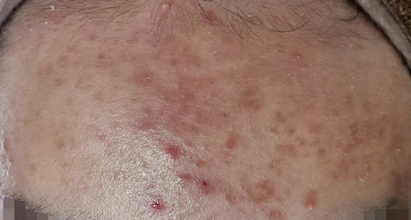 ニキビ治療の症例写真 フォトフェイシャルM22とVビームで化膿ニキビを治療,Before,ba_ipl009_b01.jpg