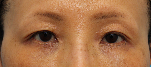 症例写真,くぼみ目ヒアルロン酸注射の症例写真,After（治療直後）,ba_kubomi008_b01.jpg