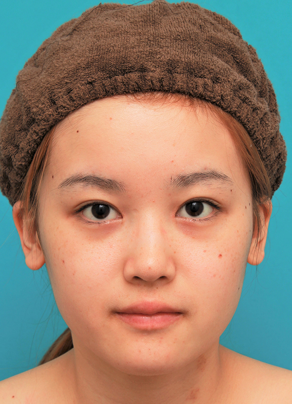顔専用脂肪溶解注射とエラボツリヌストキシンで小顔になった20代女性の症例写真,After（メソシェイプフェイス2回+エラボツリヌストキシン注射後）,ba_meso_face015_a01.jpg