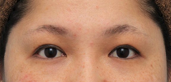 症例写真,他院での眼瞼下垂手術後に二重まぶた全切開法で幅を広げる修正手術をした症例写真,Before,ba_eye_modify023_b01.jpg