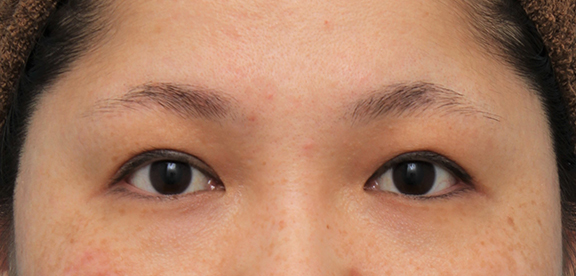 他院での眼瞼下垂手術後に二重まぶた全切開法で幅を広げる修正手術をした症例写真,Before,ba_eye_modify023_b01.jpg