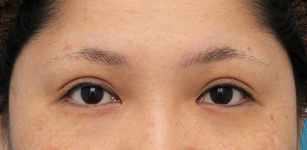 症例写真,他院での眼瞼下垂手術後に二重まぶた全切開法で幅を広げる修正手術をした症例写真,6ヶ月後,mainpic_eye_modify023d.jpg