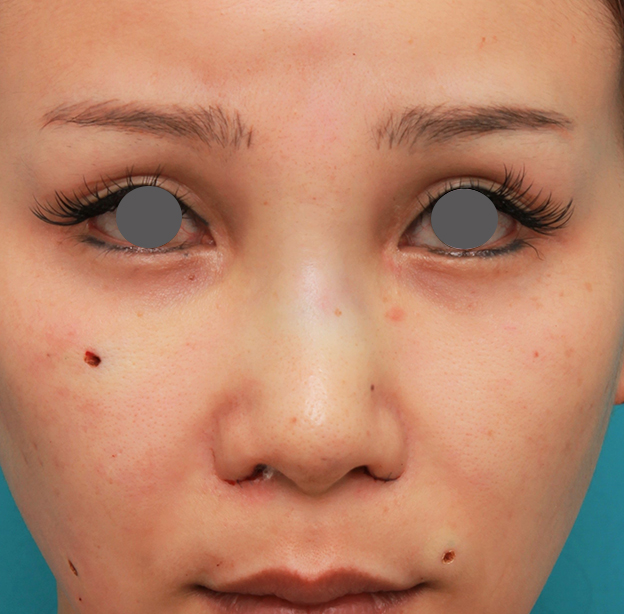 症例写真,鼻のシリコンプロテーゼ+鼻先の耳介軟骨移植+小鼻縮小を同時に行った症例写真,手術直後,mainpic_ryubi1055b.jpg