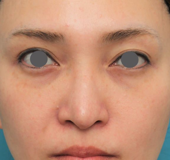 症例写真,魔女鼻に対して垂れ鼻修正手術と小鼻縮小手術を同時に行った症例写真,After（6ヶ月後）,ba_tarebana001_b01.jpg