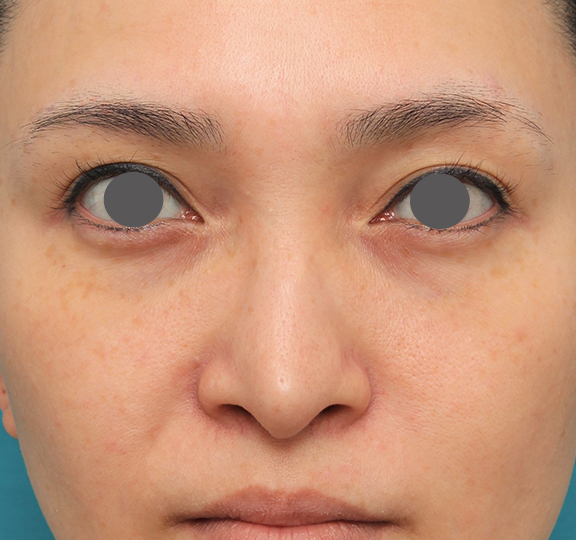 症例写真,魔女鼻に対して垂れ鼻修正手術と小鼻縮小手術を同時に行った症例写真,Before,ba_tarebana001_b01.jpg