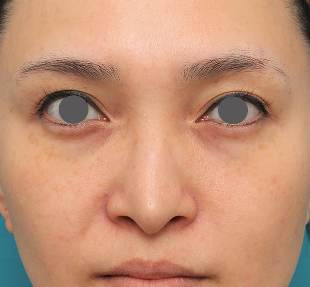 症例写真,魔女鼻に対して垂れ鼻修正手術と小鼻縮小手術を同時に行った症例写真,手術前,mainpic_tarebana001a.jpg