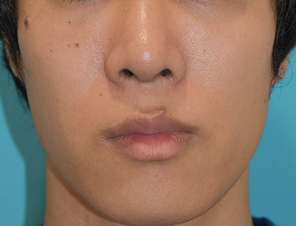 症例写真,鼻尖形成の症例写真,After（1ヶ月後）,ba_bisen028_b01.jpg