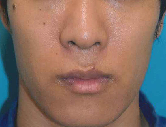 鼻尖形成の症例写真,Before,ba_bisen028_b01.jpg