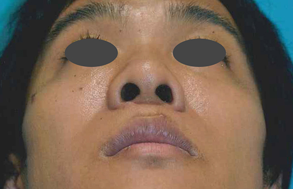 症例写真,鼻尖形成の症例写真,Before,ba_bisen028_b03.jpg