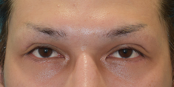 眼瞼下垂+目頭切開+目尻切開+垂れ目形成の症例写真,After（1年後）,ba_ganken041_a01.jpg