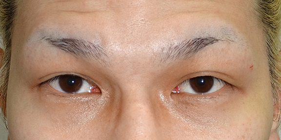 眼瞼下垂+目頭切開+目尻切開+垂れ目形成の症例写真,Before,ba_ganken041_b01.jpg