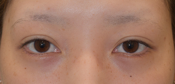 垂れ目形成・下眼瞼下制術の症例写真,After（2ヶ月後）,ba_panda021_a01.jpg