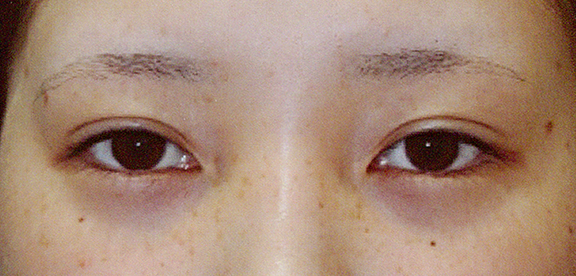 垂れ目形成・下眼瞼下制術の症例写真,Before,ba_panda021_b01.jpg