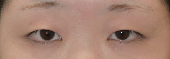 二重まぶた・全切開法の症例 一重瞼から二重瞼になった女性,Before,ba_sekkai069_b01.jpg
