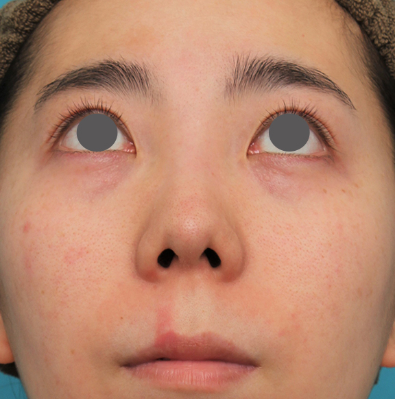 症例写真,非常に鼻の下が長い人に対して人中短縮と鼻柱への耳介軟骨移植を行った症例写真,Before,ba_hanashita003_b02.jpg