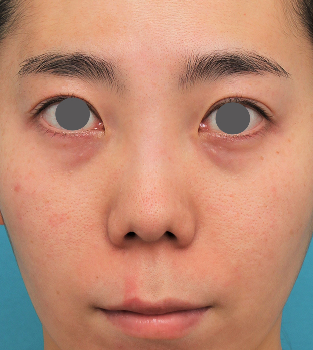 症例写真,非常に鼻の下が長い人に対して人中短縮と鼻柱への耳介軟骨移植を行った症例写真,手術前,mainpic_hanashita003a.jpg