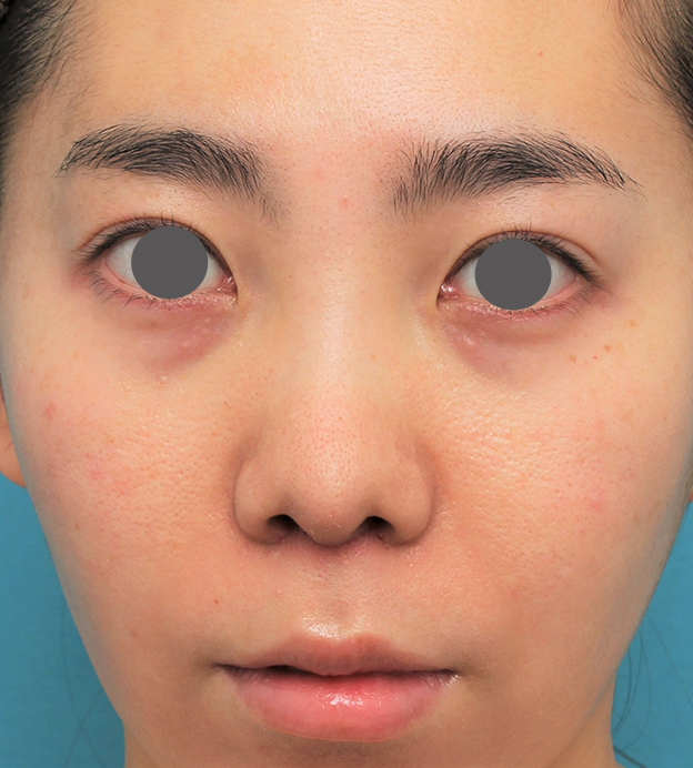 症例写真,非常に鼻の下が長い人に対して人中短縮と鼻柱への耳介軟骨移植を行った症例写真,6日後,mainpic_hanashita003c.jpg