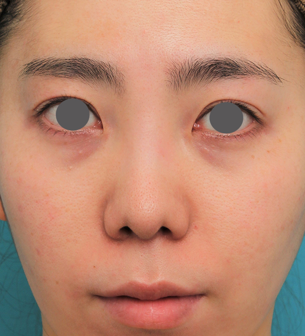 症例写真,非常に鼻の下が長い人に対して人中短縮と鼻柱への耳介軟骨移植を行った症例写真,3週間後,mainpic_hanashita003d.jpg