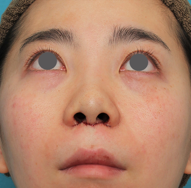症例写真,非常に鼻の下が長い人に対して人中短縮と鼻柱への耳介軟骨移植を行った症例写真,手術直後,mainpic_hanashita003g.jpg