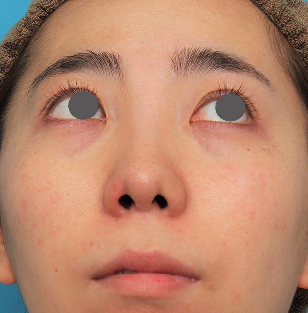 耳介軟骨移植（鼻先を出す）,非常に鼻の下が長い人に対して人中短縮と鼻柱への耳介軟骨移植を行った症例写真,6ヶ月後,mainpic_hanashita003j.jpg